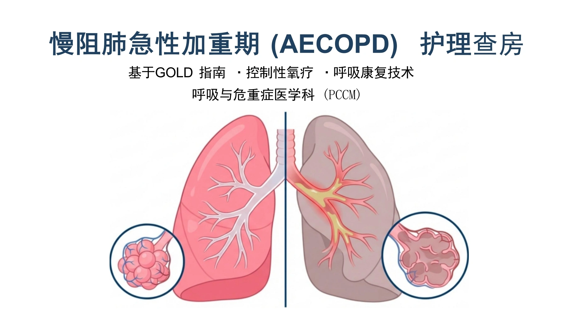 慢阻肺急性加重期护理查房-医护课栈